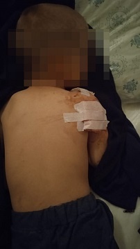 На Катеринопільщині стафф-тер’єр напав на 5-річного хлопчика. У дитини перелом плечової кістки 